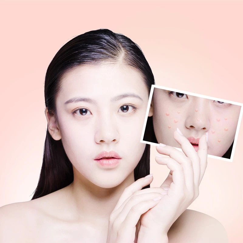 acnes acne care