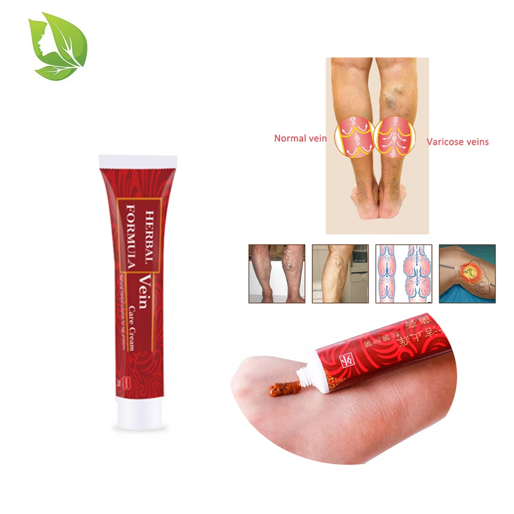 

Drop Shipping Varicose Veins Treatment Cream Extra Strength Cure Vasculitis Phlebitis Spider Veins Pain Varicosity Angiitis Gel