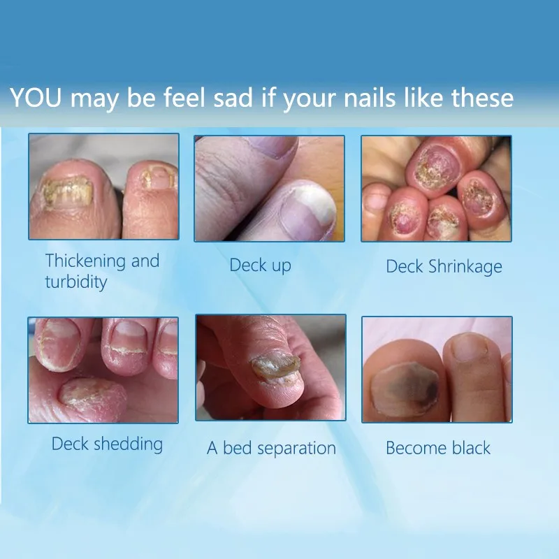 Ногти для ног "францзуский маникюр" и ногтей гриб онихомикоз удаления Антибактериальный масло Лечение грибка ногтей