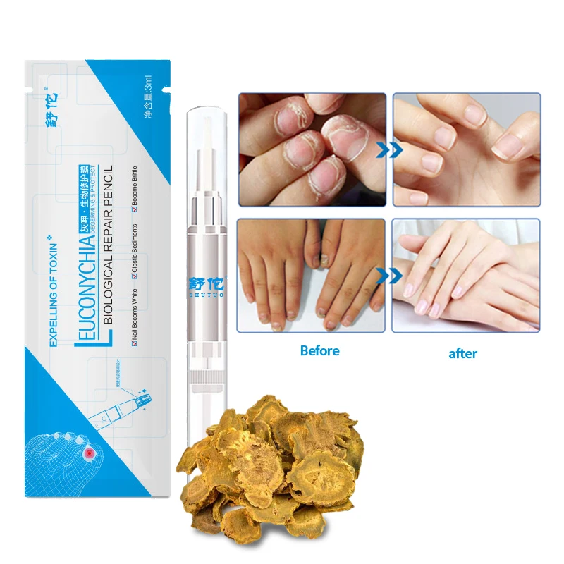 

Nail Treatment Pen Onychomycosis Paronychia Anti Fungal Nail Infection Good Result Chinese Herbal Toe Nail Fungus Treatment