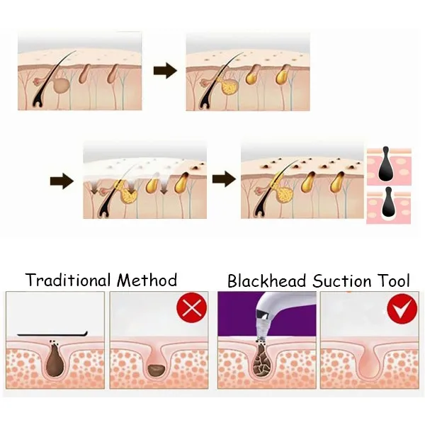 Y.F.M<ALIMT >®</ALIMT> Rechargeable Electric Blackhead Suction Acne Remover Vacuum Microdermabrasion Pore Cleanser Facial Skin