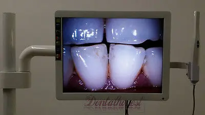 Стоматологическая 8-светодиодный Intraoral камера с 17 "ЖК-монитором и держателем для стоматологического крепления