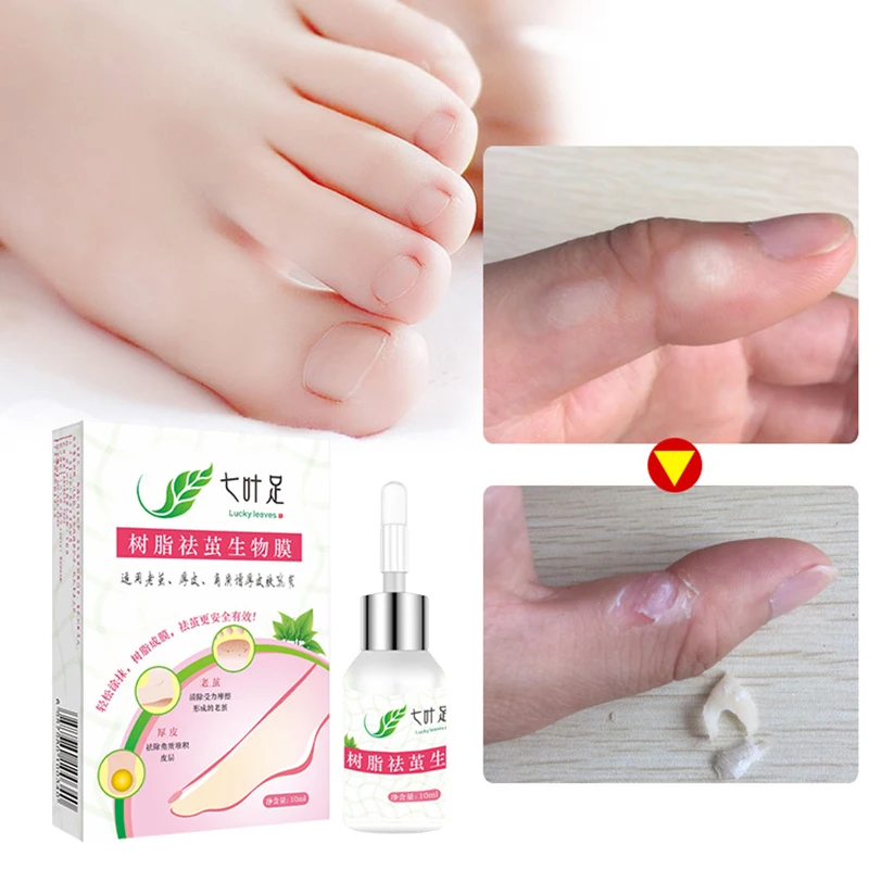 Foot Corn Remover Useful Foot Callus Remover Cure Callus cream Health
