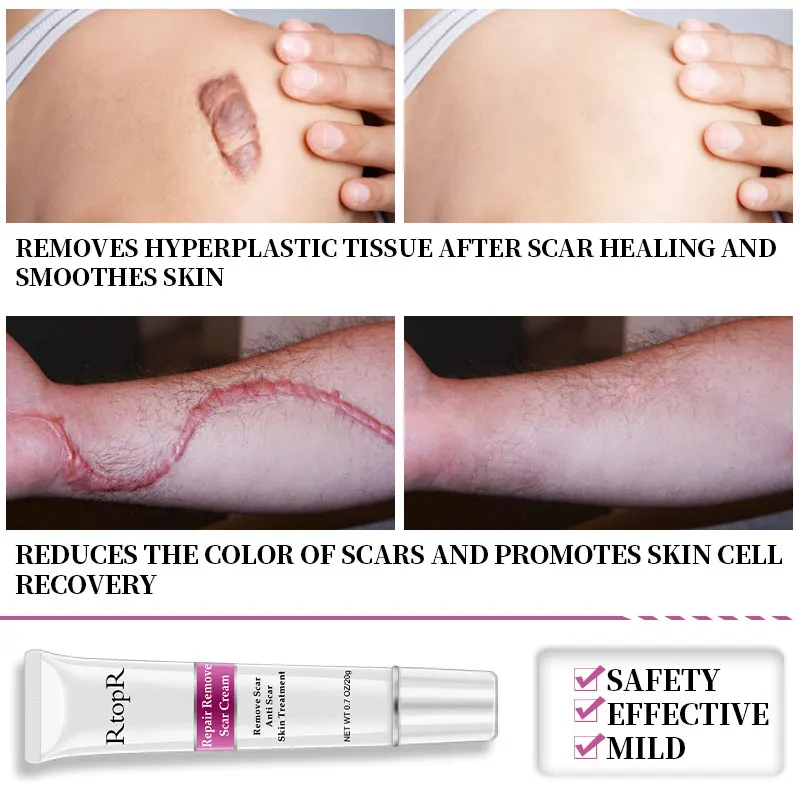 Tree-of-Life RtopR Acne Scar Removal Cream Fast Skin Tag Remover Remove Scar Cream Scar Gel 