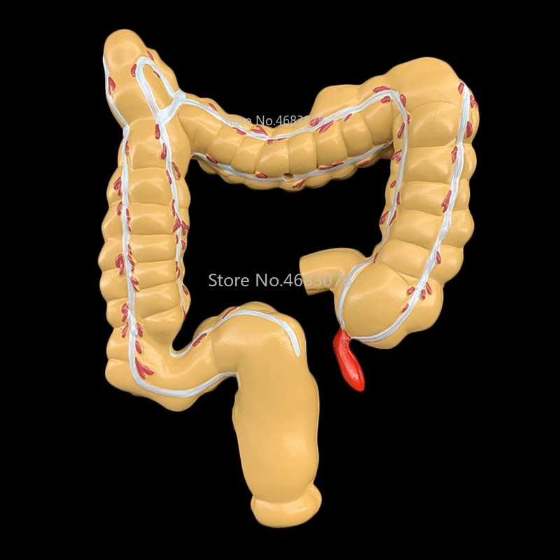 Колоректального модель поражения человека толстой кишки для стоматологов патологическая заболеваний модель медицинский Органайзер анатомии 14x17x21 см