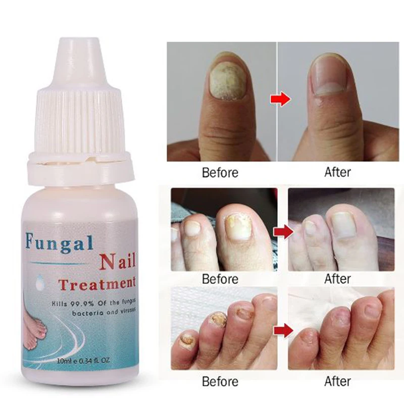 10ML Fungal Nail Treatment Onychomycosis Nail Repair Liquid Nourishing For Manicure Cuticle