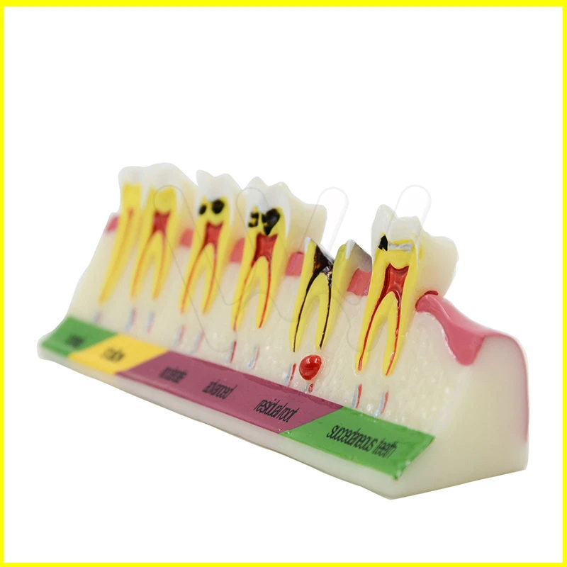 Dental-Caries-Developing-illusteation-Tooth-Model-Demonstration-Teach-_57 (3)