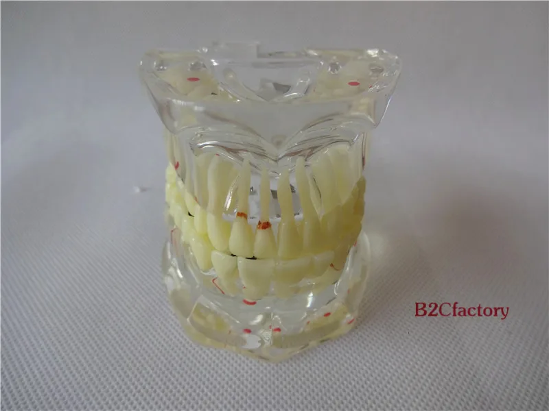 

Dental Implant Disease Tooth Pathological Extrusion Missing Teeth Model 4001