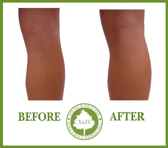 

BEST VARICOSE VEINS LEGS VESSELS & SPIDER VEINS REMOVER CREAM TREATMENT