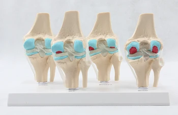 

Anatomical Human Degenerative Knee Joint DiseaseSkeleton Anatomy skull anatomical brain model mixer in trauma esqueleto anatomia