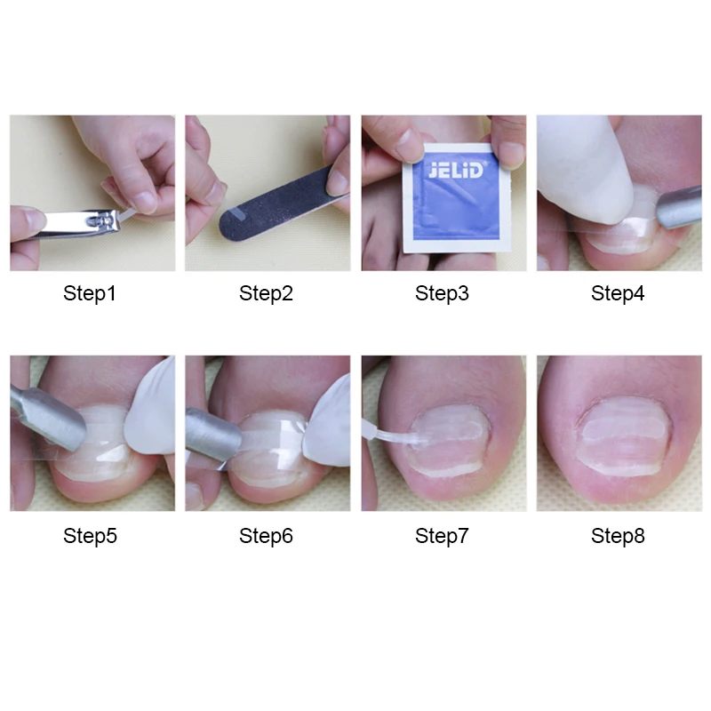 10pcs/Box Nail Ingrown Correction Toe Sticker Patch Fixed Foot Care Recover Correction Toenail File Corrector Pedicure Tools