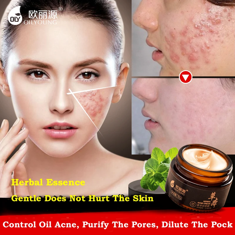 прыщей лице крем самый. крем анти-акне bioaqua. средства от акне и прыщей. крем анти-акне bioaqua. крем против угрей и шрамов для лица.