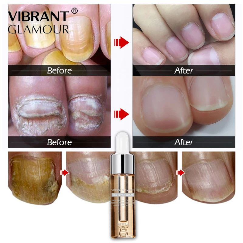 

Nail Repair Serum Nail Treatment Essence Fungus Onychomycosis Removal Anti Fungus Nail Toe Nourishing Nail Care VIBRANT GLAMOUR
