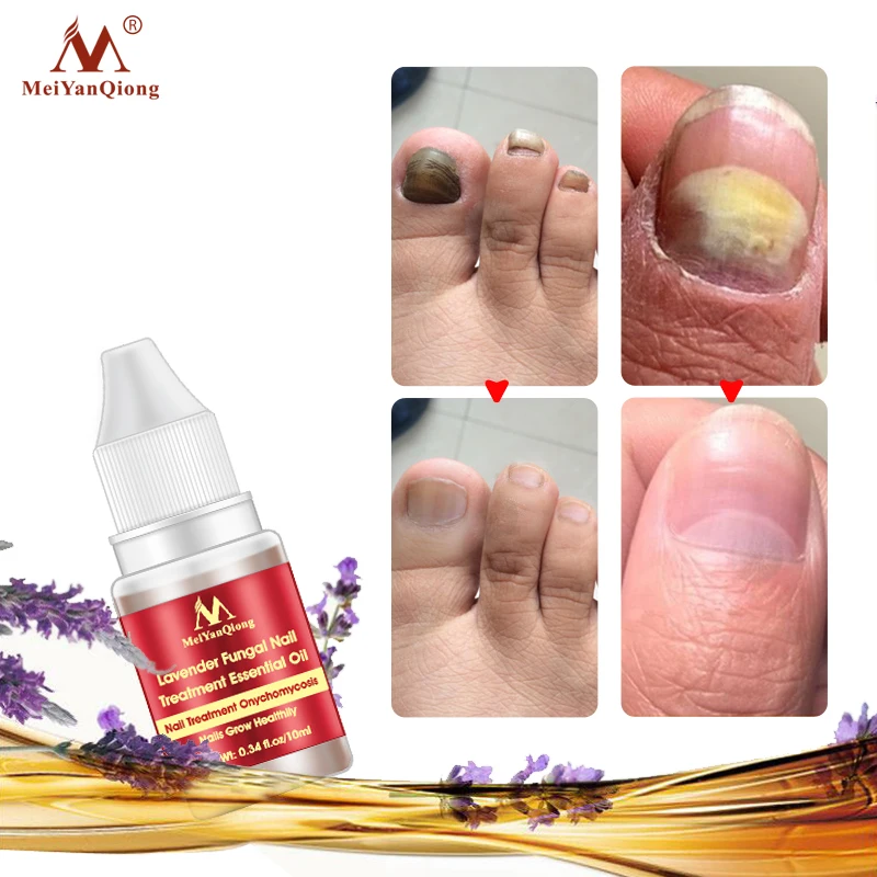 Lavender Fungal Nail Treatment Essential Oil Nail Art & Tools Promote Nails Grow Healthy Nail Treatment Onychomycosis Foot Care Lavender Fungal Nail Treatment Essential Oil Nail Art & Tools Promote Nails Grow Healthy Nail Treatment Onychomycosis Foot Care