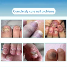 Противогрибковый крем-ручка для ногтей, Лечение грибка, инфекция, яркий для спортсменов, для ног, SSwell