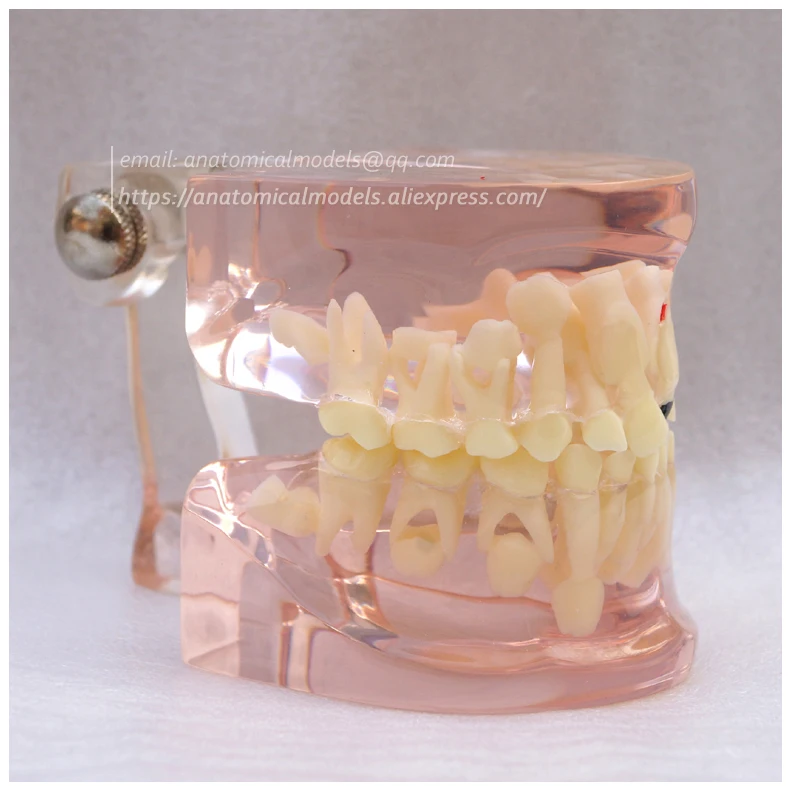 13062 Clear Mixed Age model with Caries 3 