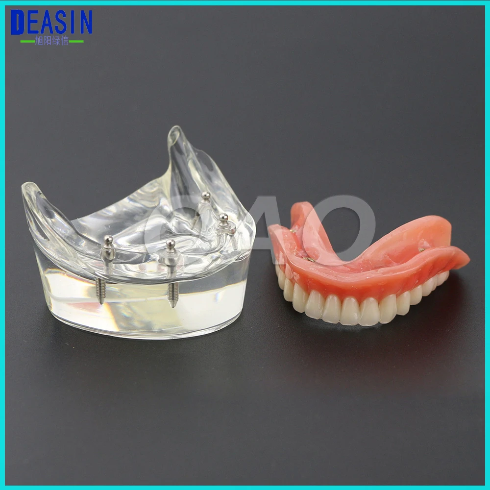 Dental Teaching Teeth Study Model Overdenture Inferior 4 Implant Demo Model цена Dental Teaching Teeth Study Model Overdenture Inferior 4 Implant Demo Model цены онлайн