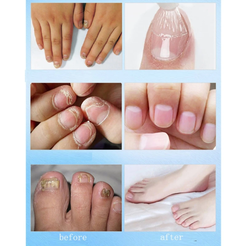 Fungal Nail Treatment Pen Essence Nail Foot Whitening Toe Nail Fungus Removal Feet Care