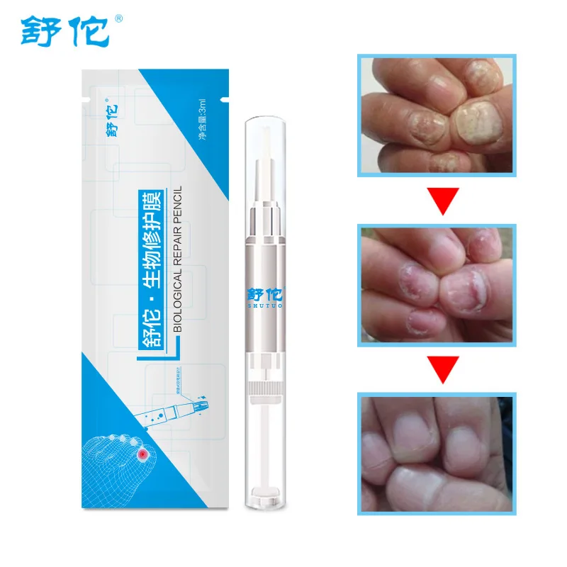 

3 ML Anti Schimmel Behandeling Nail Pen Onychomycose Paronychia Infectie Kruiden Teen Vinger Nagels Gezondheid Beauty Accessoire