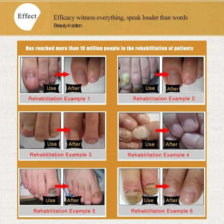 Fungal Nail Treatment Essence Nail And Foot Fungus Removal Feet Care Gel #F