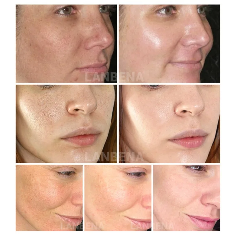 2019 Vitamin C Serum Lyophilized Powder Set Moisturizing Whitening Nourishing Remove Melanin Shrink Pores Repairing Skin Care 2019 Vitamin C Serum Lyophilized Powder Set Moisturizing Whitening Nourishing Remove Melanin Shrink Pores Repairing Skin Care