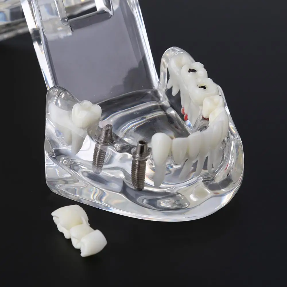 Горячая зубной имплантат, зубная модель с реставрационным мостом, зубной Стоматолог для медицинских исследований