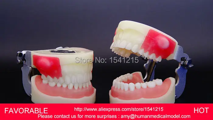 

DENTAL CARIES MODEL,DENTAL DENTAL MODEL ,DENTAL CAST MODEL DEPARTMENT OF DENTISTRY DISPLAY,MEDICAL ANATOMY MODEL-GASEN-DEN004