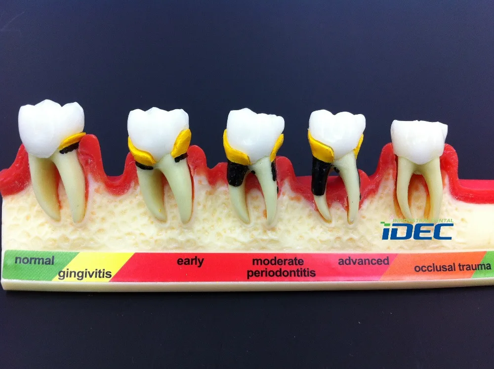 Стоматологическая модель зубов пародонтальная болезнь Assort зуб классификация модель 1 шт