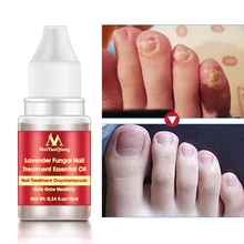 Убивает 99.9% бактерий и грибок ногтей грибок лечение крем Onychomycosis Paronychia против грибковой инфекции ногтей 10 мл