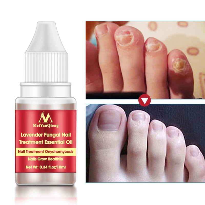 

Original Kills 99.9% Bacteria and Fungus Nail Fungus Treatment Cream Onychomycosis Paronychia Anti Fungal Nail Infection 10ml