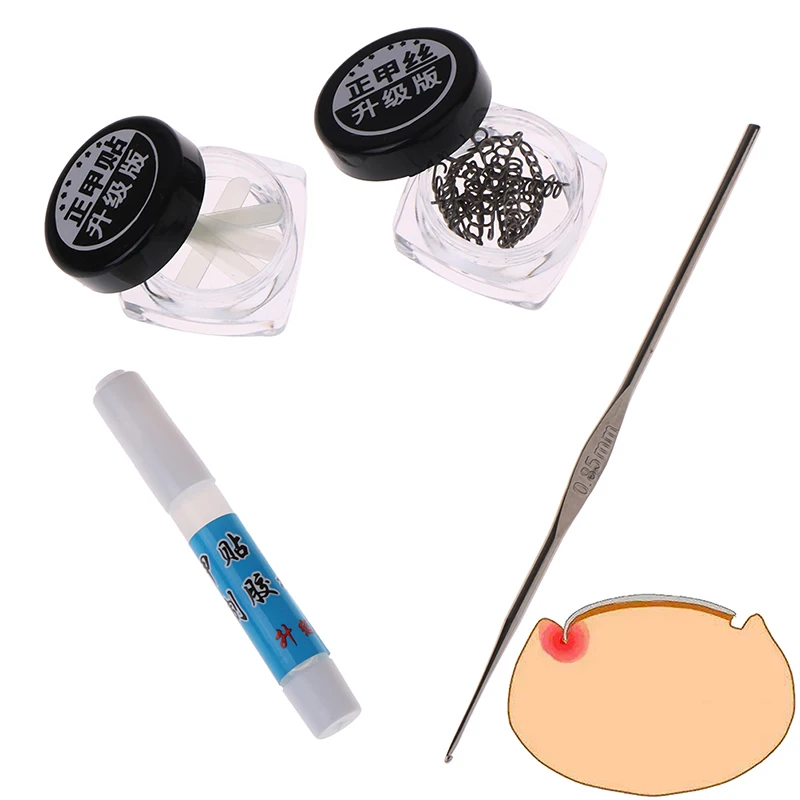 

1PCS Ingrown Toe Nail Correction Wire Sticker Tool Fixer Pedicure Paronychia Recover Toenails Corrector Foot Care Tool