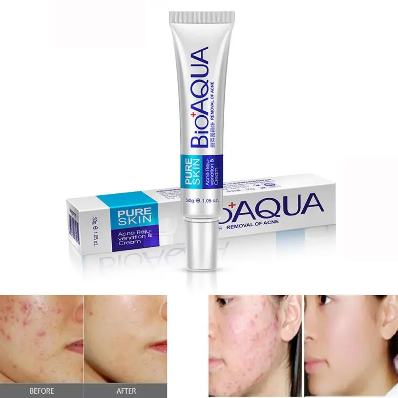 

BIOAQUA New Men and Women Effective Face Skin Care Removal Cream Acne Spots Scar Blemish Marks Treatment 2017 Anne