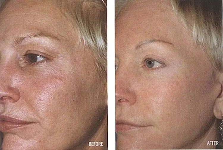 Vitamin C Serum For Face Before And After