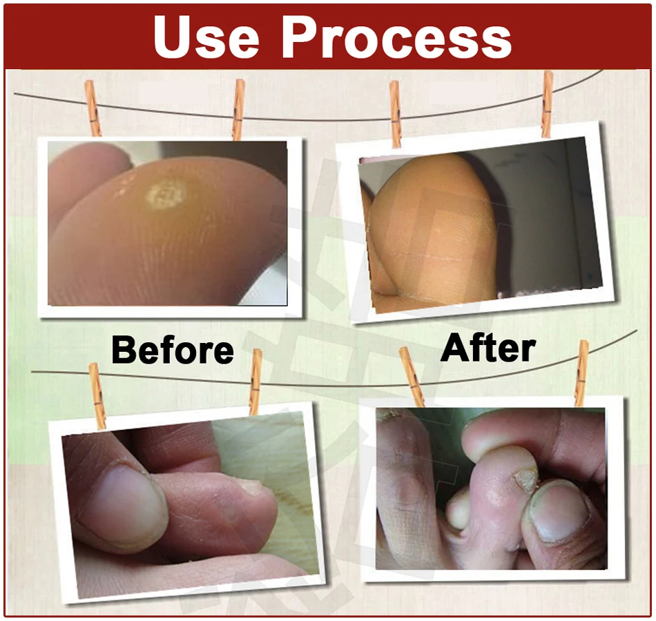 40Pcs Skin germ Corn Remover Plaster Foot Corn Removal Patch for