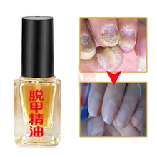 Лечение ногтей Удаление онихомикоза Paronychia пергаментная бактерицидная инфекция ногтей грибковая инфекция ногтей Лечение грибка