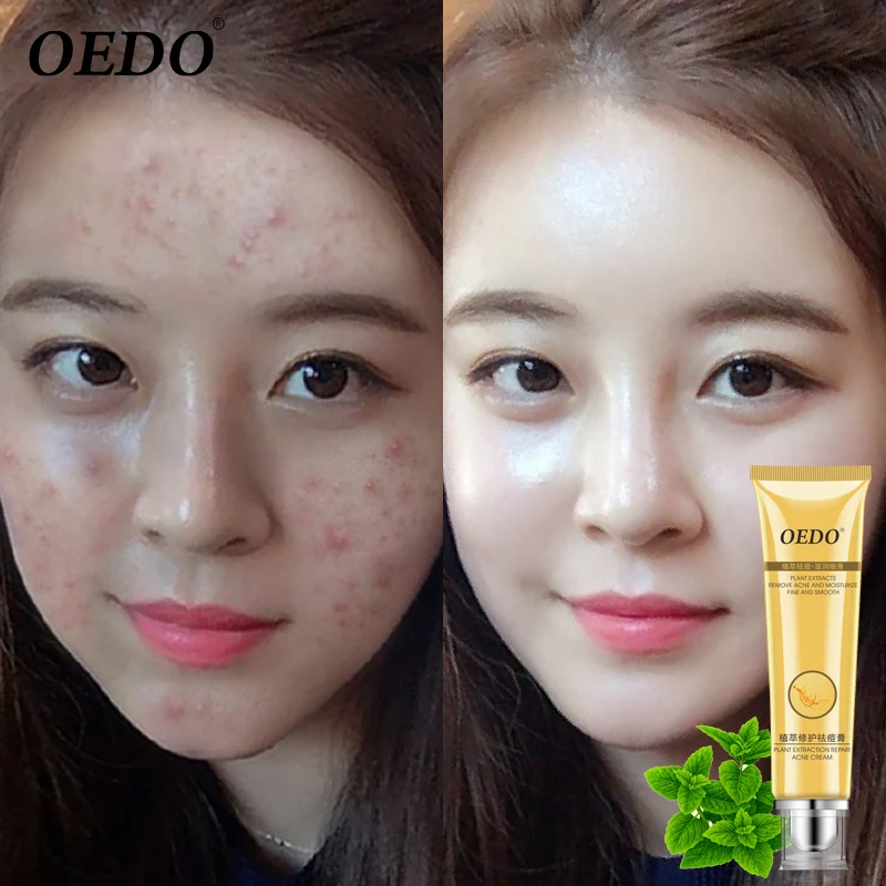Herbal plant extract repair cream remove acne marks repair rough pores deep cleansing facial horny facial skin care cream 20g