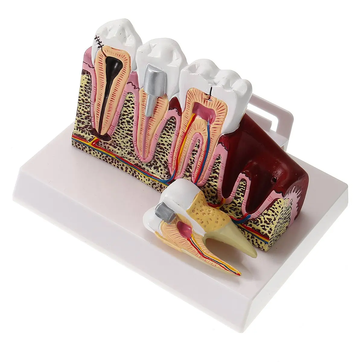 

Detachable Dental Oral Caries Demonstration Model Anatomical Teeth Common Pathologies Model For Medical Science Teaching Study