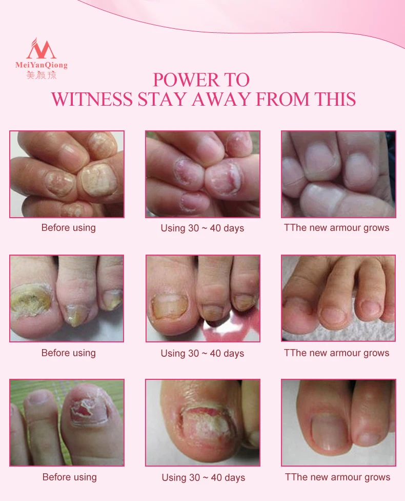 Травяное Лечение ногтей onychomicosis Paronychia против грибковой инфекции ногтей хороший результат Китайский Травяной Уход за ногтями