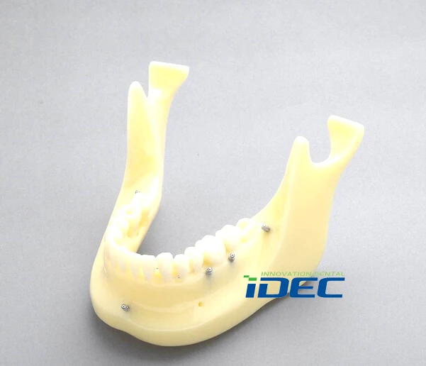 Зубные модели Ортодонтические Мини Винт демонстрация зубы модель имплантата M2016