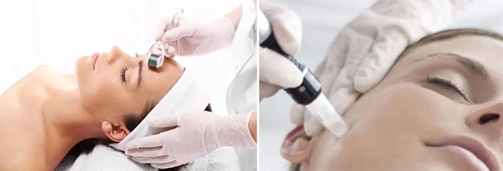 Micro-needling (13)