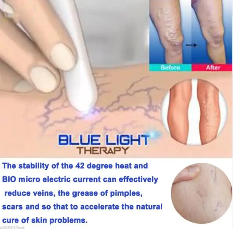 Синяя световая лазерная ручка лечение акне удаление морщин шрамов машина терапия ручка Массаж варикозное расширение вен лечение кожи лифтинг инструмент