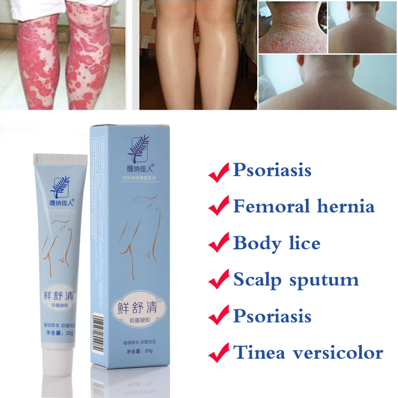 29A Natural Cream Works Really Well For Psoriasi Eczma Skin Care