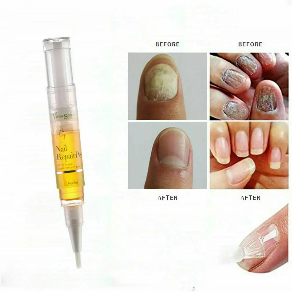 Средство для восстановления ногтей, жидкая ручка, против грибков, онихомикоза, эссенция для удаления