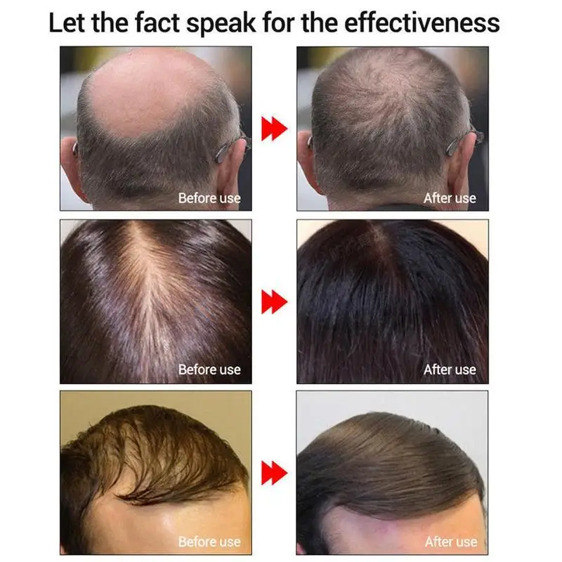 Andrea Hair Growth Serum Oil Herbal Keratin Fast Hair Growth Alopecia Loss Liquid Ginger Sunburst Yuda Pilatory Oil Andrea Hair Growth Serum Oil Herbal Keratin Fast Hair Growth Alopecia Loss Liquid Ginger Sunburst Yuda Pilatory Oil