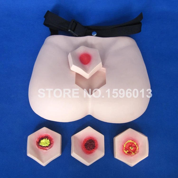 Decubitus Ulcer Stages Care Model Pressure Ulcer Sores Training Simulator mooren s ulcer and peripheral ulcerative keratitis