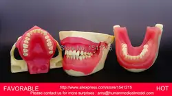 Кариеса модель, стоматологические модели, Стоматологическая Литой Модель для Отдела стоматологии дисплей, медицинская Анатомия MODEL-GASEN-DEN007