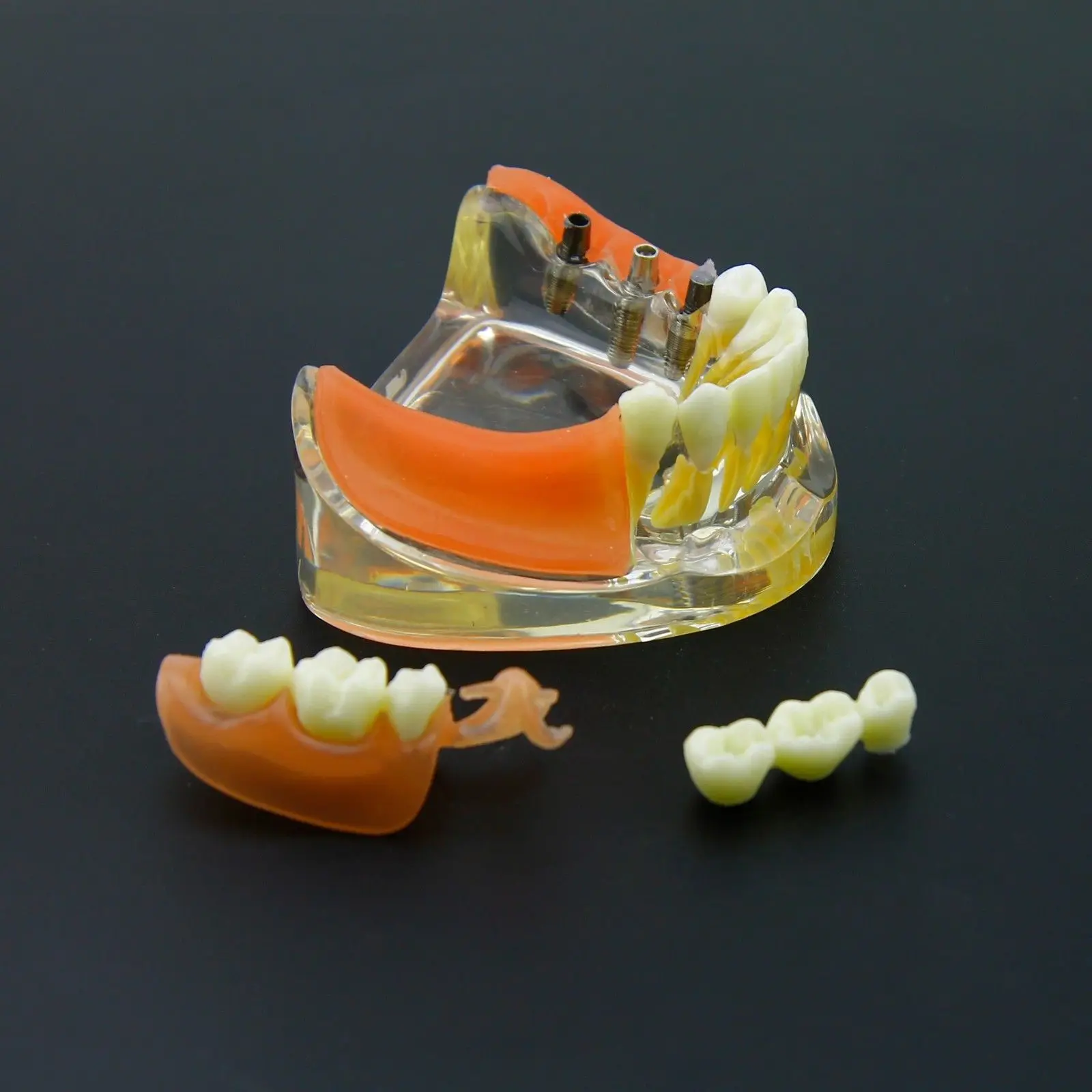 Стоматологический имплантат Восстановление зубов Модель съемный мост протез Demo#6006
