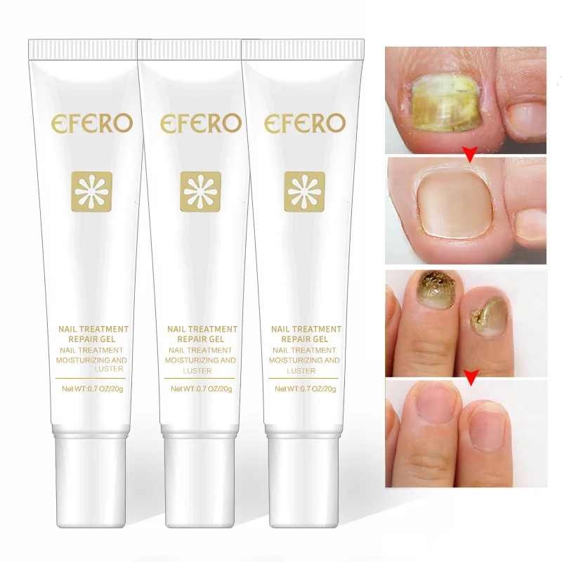 

Efero Anti Infection Feet Care Essence Toe Nail Fungus Removal Gel Nails Repair Essence Fungal Nail Treatment New TSLM1