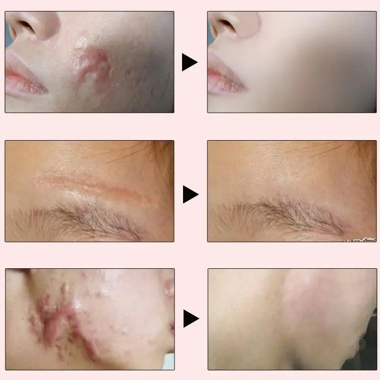 Scar Removal Acne Scar Removal Scar Cream Laser Scar Removal