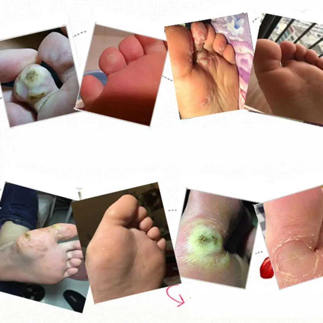 50 piezas de yeso de maíz sin dolor removedor de maíz pies cuidado de color caqui verrugas parche de yeso de espino para pies 50 piezas de yeso de maíz sin dolor removedor de maíz pies cuidado de color caqui verrugas parche de yeso de espino para pies